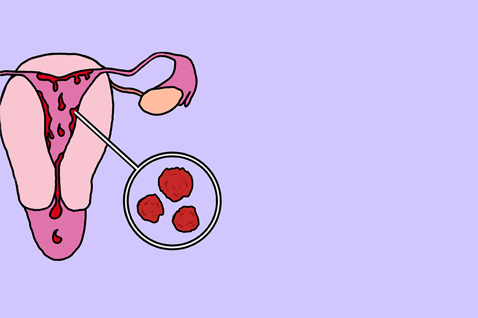 Adet dönemindeki kan pıhtıları ne anlama geliyor?